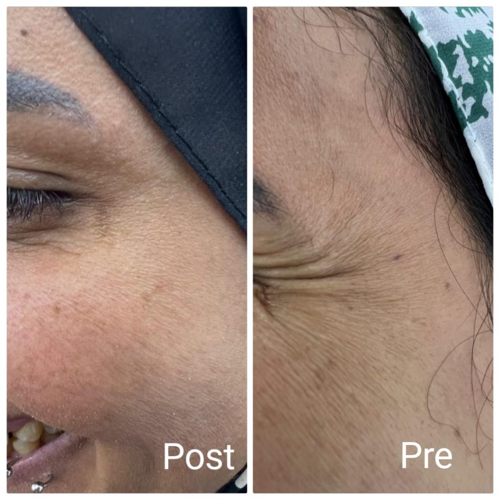 Eye Botox and Botox injections for wrinkles around the eyes